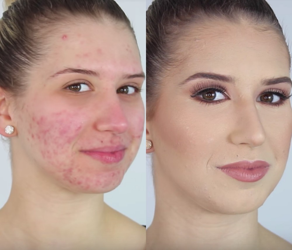 Acne-Prone Skin: Definition, Causes, and Prevention