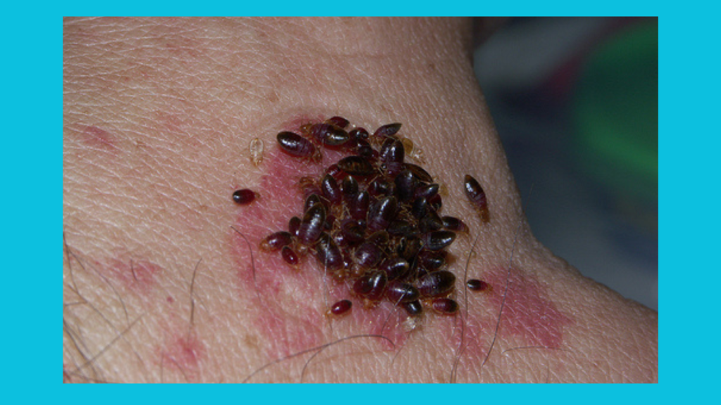 How To Deal With Bedbug Bites Quickly And Effectively