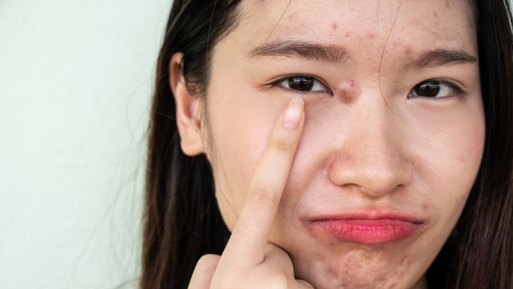 What causes facial pimples and how to stop them